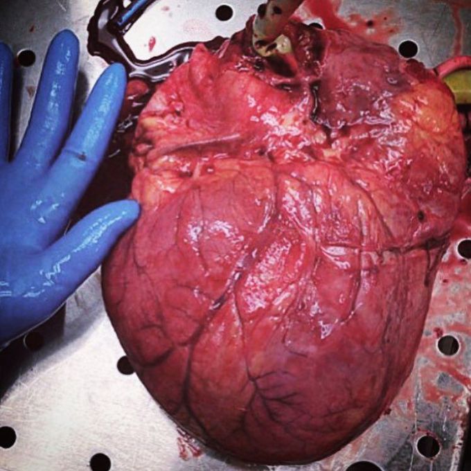 Cardiomegaly  | Homeopathic | Best Homeopathic Doctor in Pakistan | Dr Qaisar Ahmed MD, DHMS