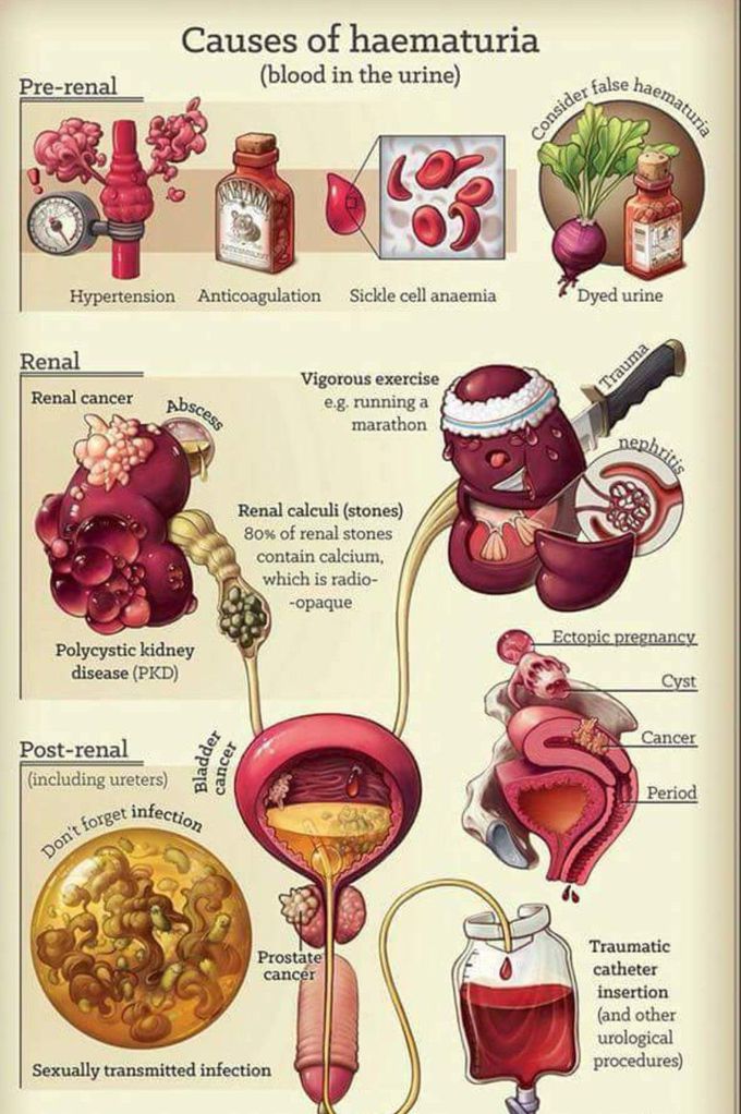 Causes of Hematuria [Image]