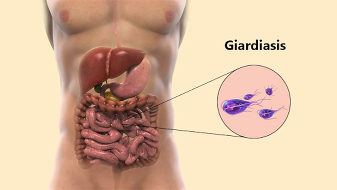 Cause of Giardiasis