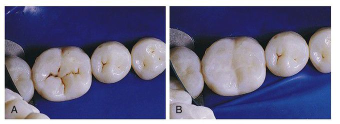 Typical molar with stained fissures and no diagnosable caries.