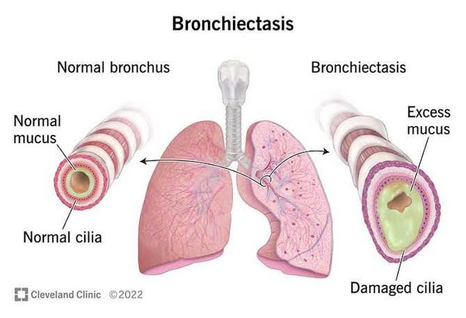 Broncheictasis