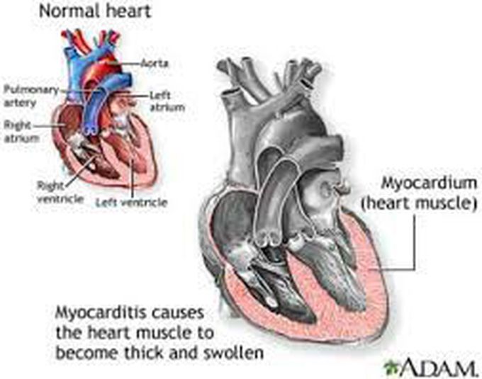 Myocarditis