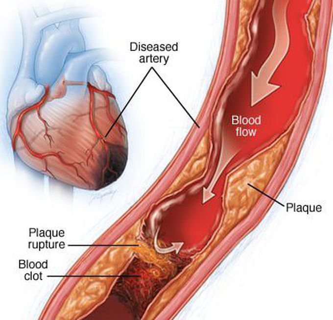 Myocardial Ischemia