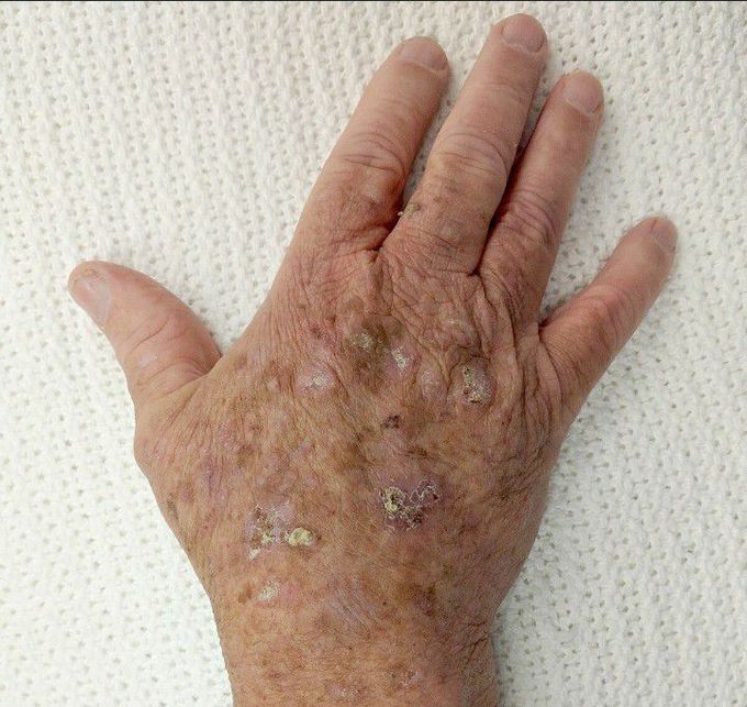 Actinic keratosis