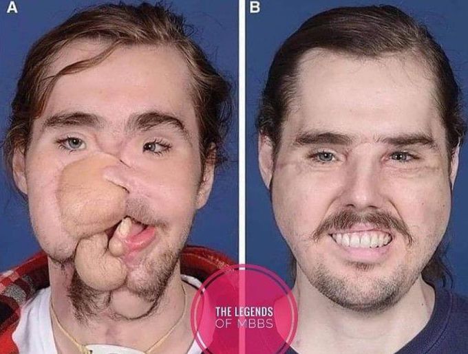 Facial transplantation