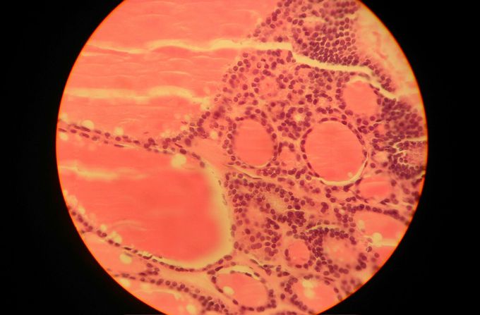 Microscopic look of goiter
