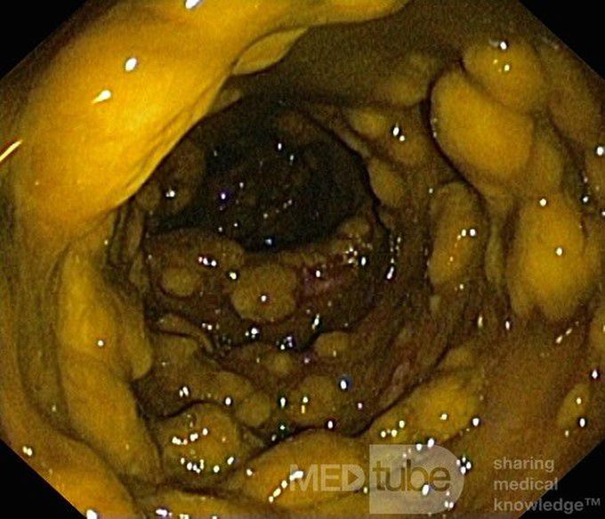 Antibiotics Causing Pseudomembranous Colitis