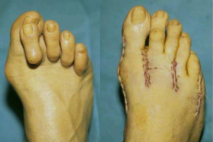 Hammertoe Surgery