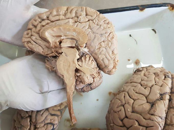 Brain Hemisection.......###