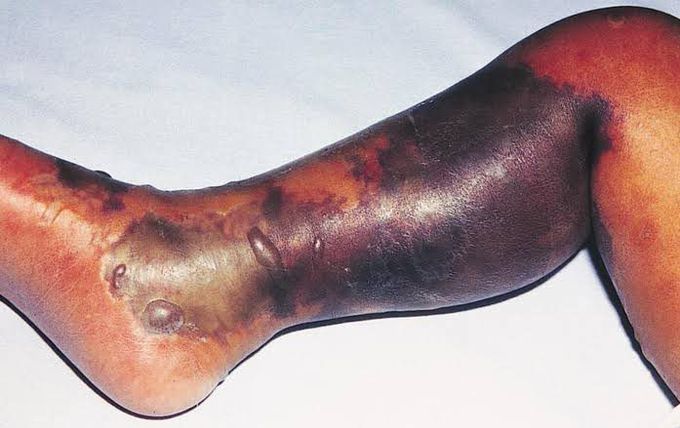 Necrotizing Fasciitis
