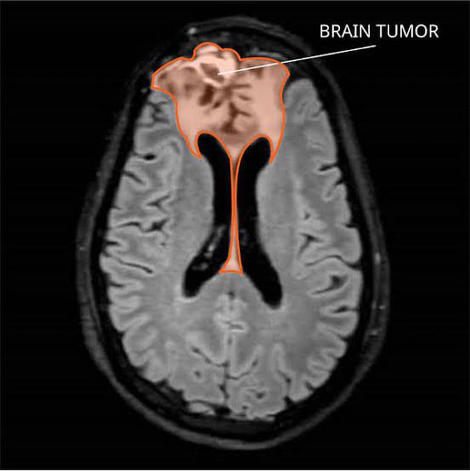 Oligodendroglioma