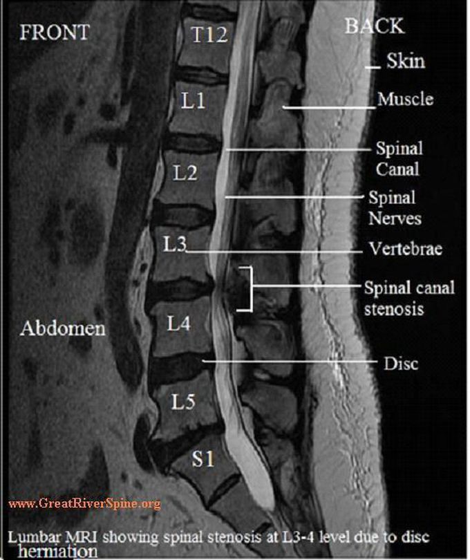Spinal canal stenosis