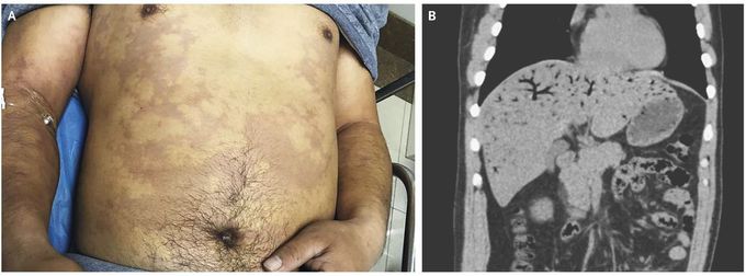 Decompression Sickness