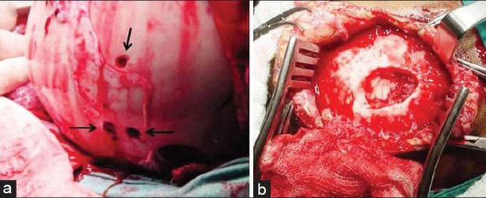 (a) Scalp view demonstrating three penetrating skull fractures (arrow) in the left frontal-parietal region caused by the lion's canines and (b) depressed skull left parietal fracture with dura mater laceration