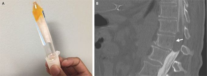Froin’s Syndrome