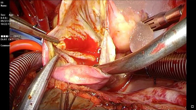 Giant Right Coronary Aneurysm: A Surgical Approach