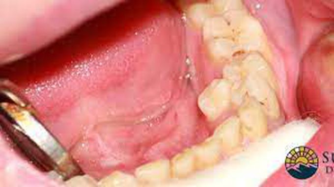 What are the symptoms of hyperdontia?