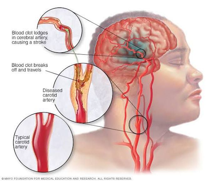 Treatment of stroke