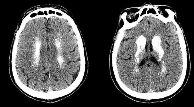 Fahr syndrome