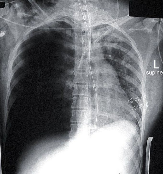 Traumatic pneumothorax!  