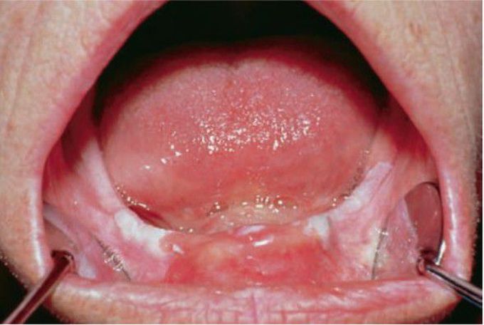 Focal hyperkeratosis