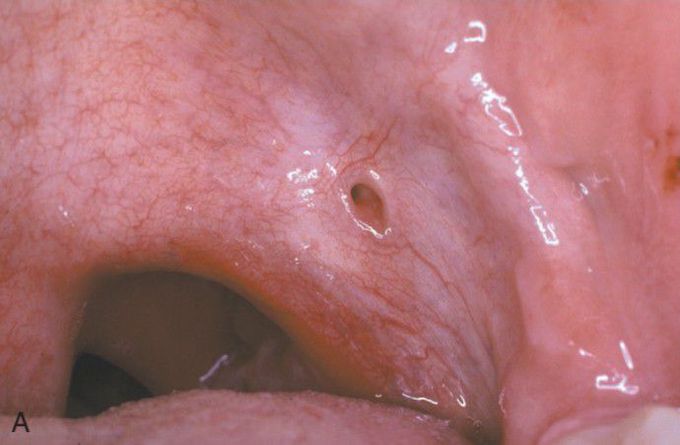 Lateral palatal fistula