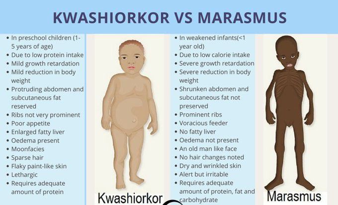 Kwashiorkor vs Marasmus | Malnutrition