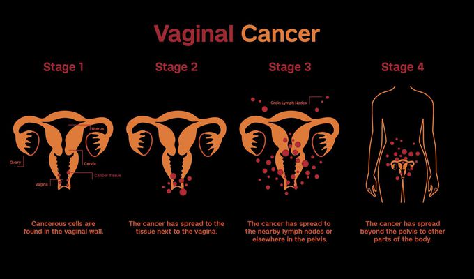 Vulval cancer