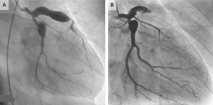 Coronary-Artery Occlusion from Kawasaki’s Disease