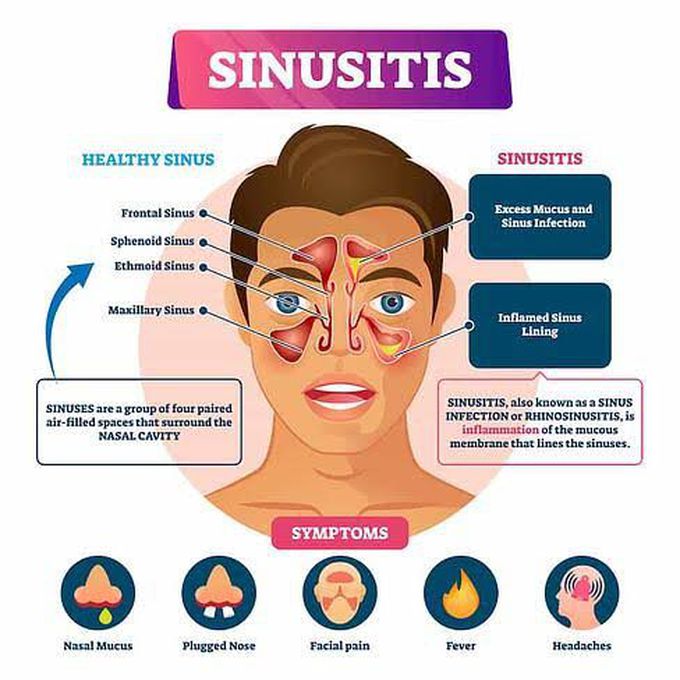 Symptoms of sinusitis