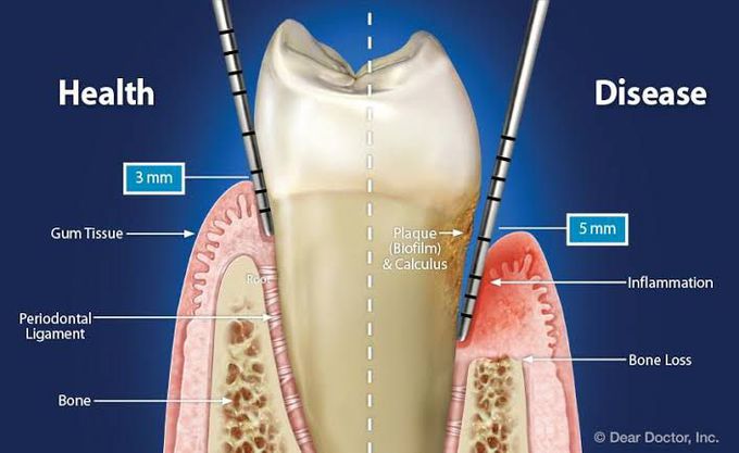 Periodontal pockets