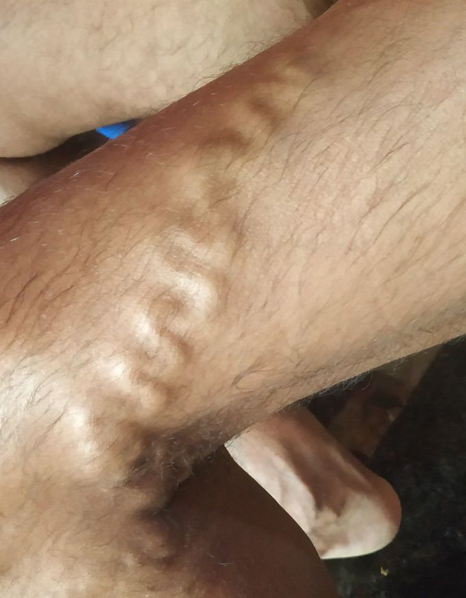Treatment
