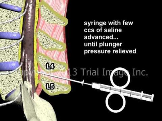 Epidural Anaesthesia