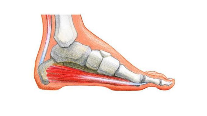 Calcaneal spur