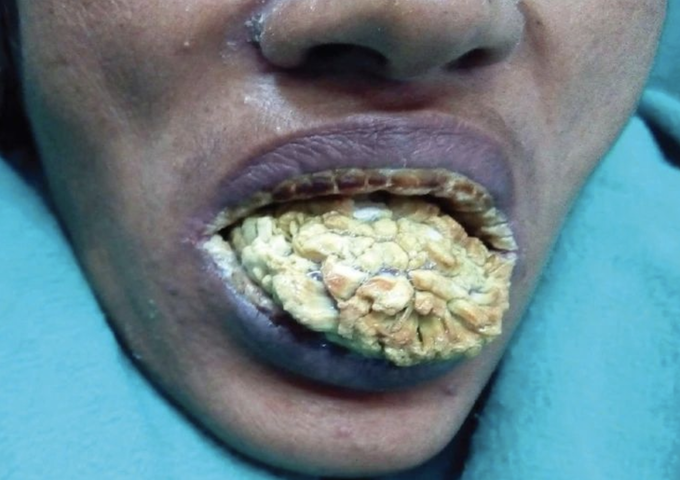 Severe hyperplastic oral candidiasis in a patient with HIV.