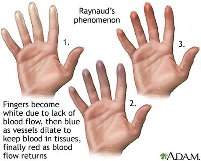 Raynaud’s Phenomenon