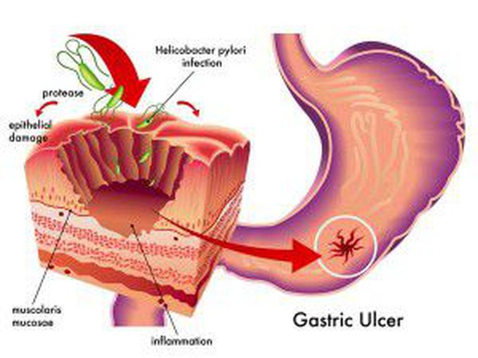 Symptom of Helicobacter pylori