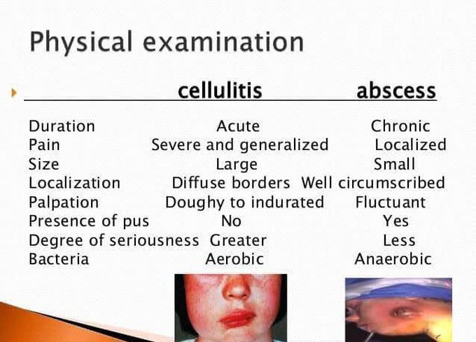 Abcess vs cellulitis