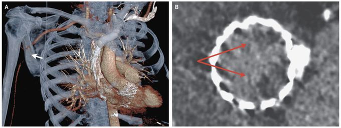 Axillary Artery Occlusion after TAVR