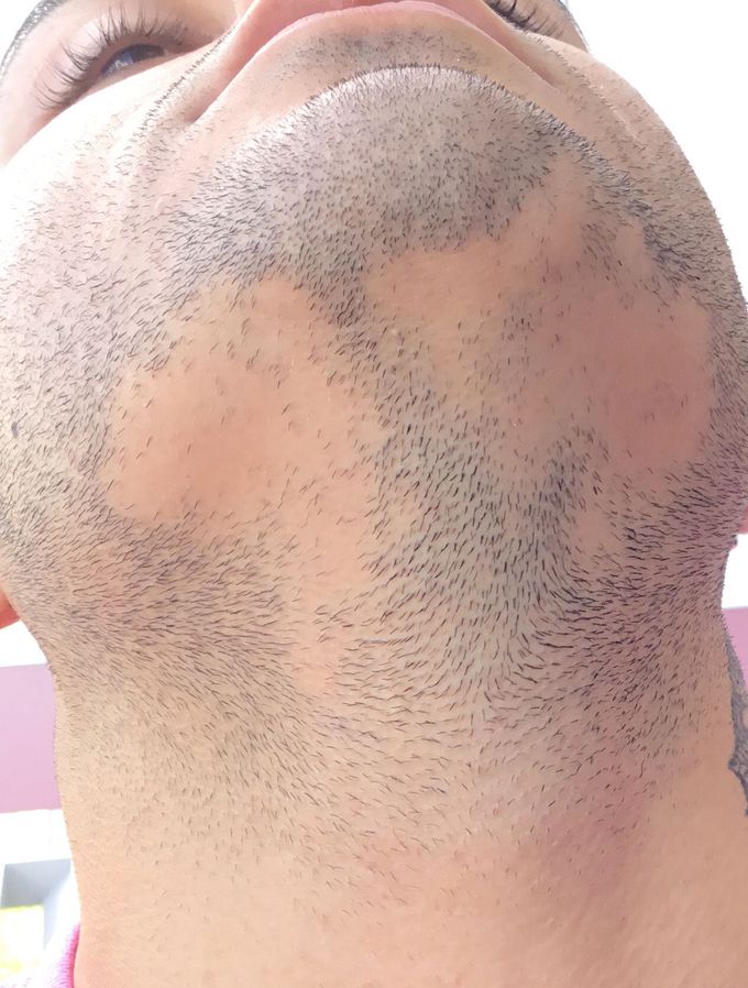 Alopecia Areata in 21 yr old male