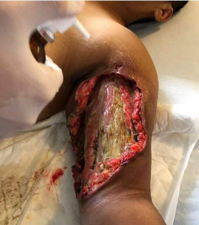 Necrotizing fasciitis