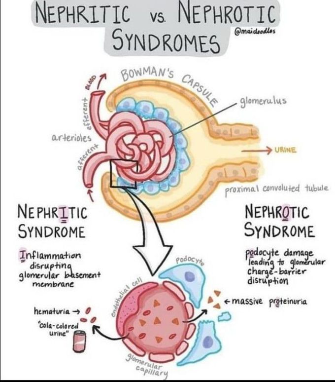 Nephritic vs nephrotic syndrome