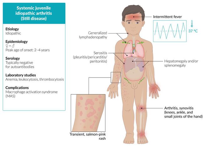 Systemic Juvenile Idiopathic arthritis (still disease)