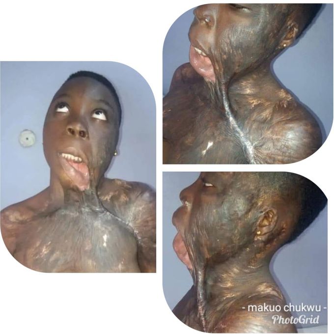 270® Burnt injury!!!
