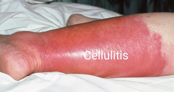 Cellulitis