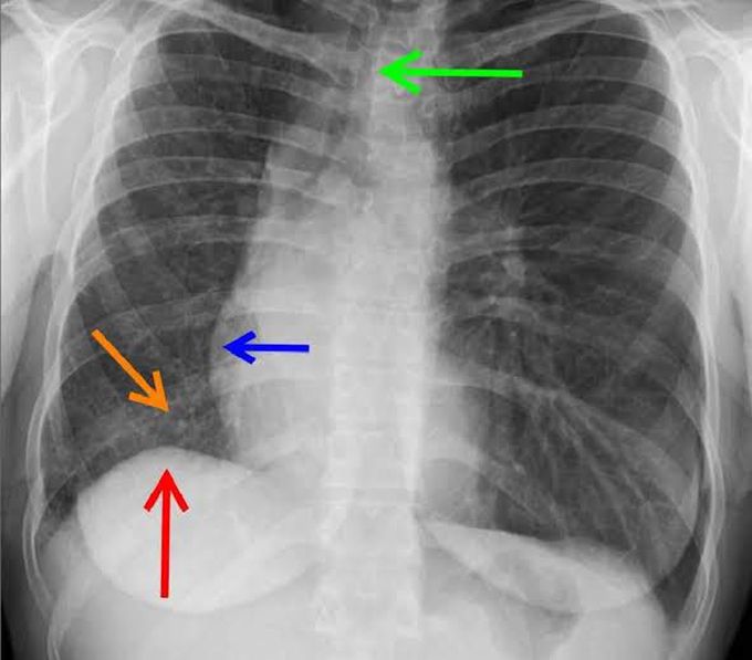 Symptoms of idiopathic pulmonary fibrosis