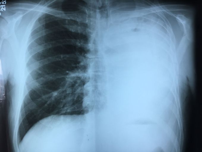 Collapsed Lung