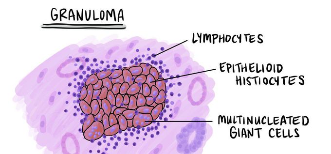 Granuloma