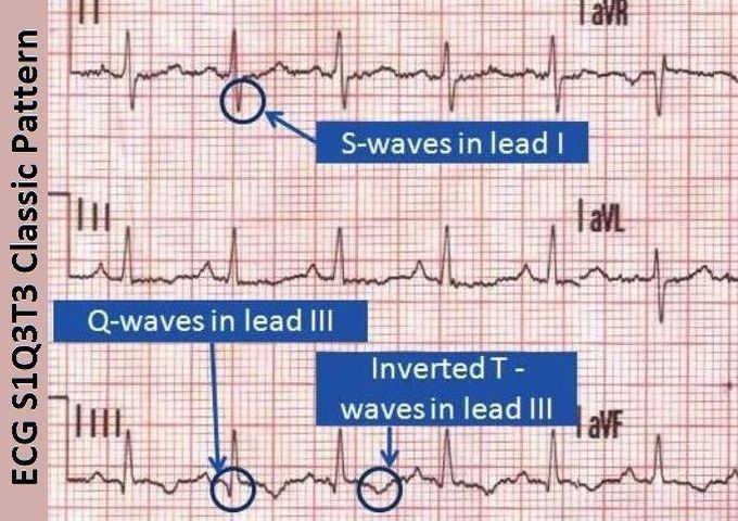 S1Q3T3 pattern on ECG in a patient with acute massive Pulmonary Embolism (PE)