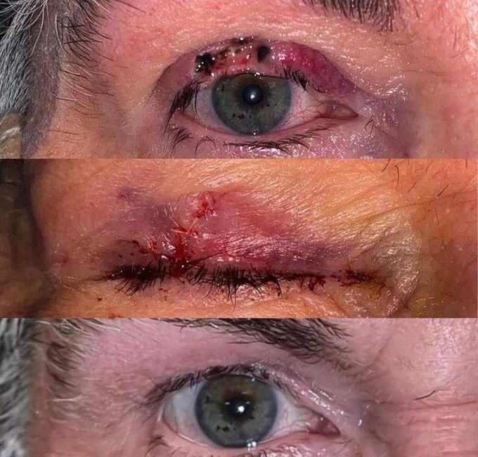 Healing of Eyelids